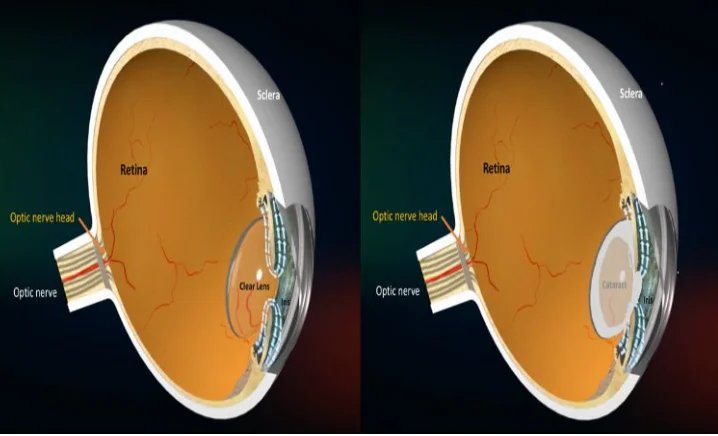 Early Warning Signs of Phacomorphic Glaucoma You Shouldn’t Ignore