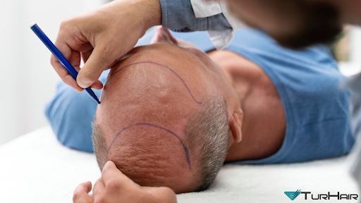 hair transplant Turkey